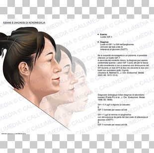 Acromegaly Diagnose Medical Diagnosis Symptom PNG
