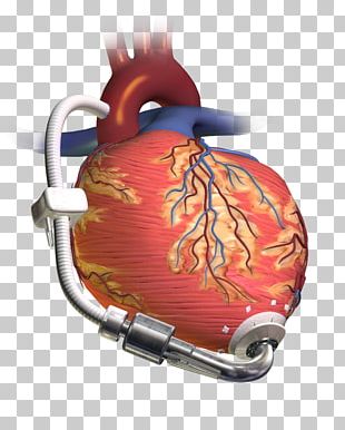 Heart Transplantation Lung Organ Transplantation PNG, Clipart, Area ...