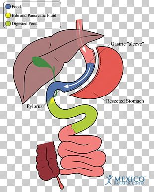 Duodenal Switch PNG Images, Duodenal Switch Clipart Free Download