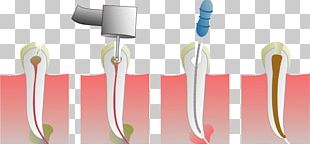 Root Canal Endodontic Therapy Dentistry Medical Procedure PNG