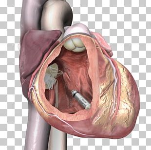 Artificial Cardiac Pacemaker Boston Scientific Implantable Cardioverter ...