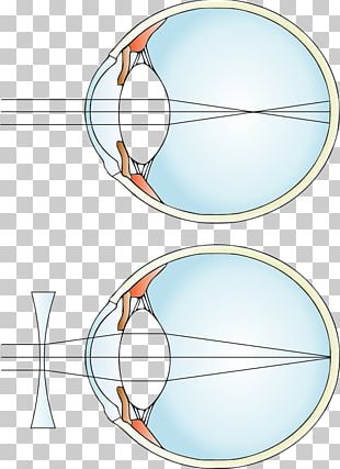 Near-sightedness Hypermetropia Corrective Lens Refractive Error PNG