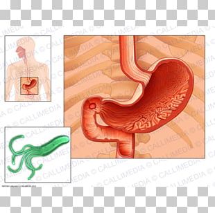 duodenal cap image clipart