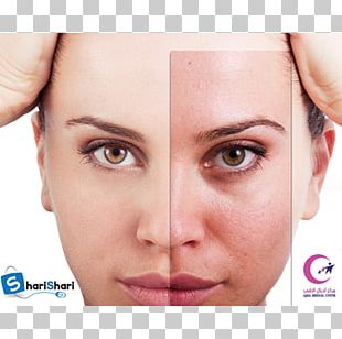 Skin Rhytidectomy Surgery Therapy Infantile Hemangioma PNG
