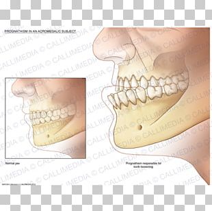 Acromegaly Gigantism Face Growth Hormone PNG, Clipart, Acromegaly ...