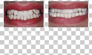 Tooth PNG, Clipart, Area, Art, Baby Teeth, Cartoon, Designer Free PNG ...