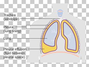 Pleurisy Pleural Cavity Pleural Effusion Lung Inflammation PNG, Clipart ...