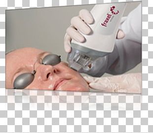 Fraxel Low-level Laser Therapy Low-level Laser Therapy Facial Rejuvenation PNG