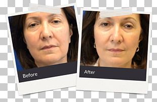 Plastic Surgery Arts Of NJ Facial Rejuvenation East Brunswick Township PNG