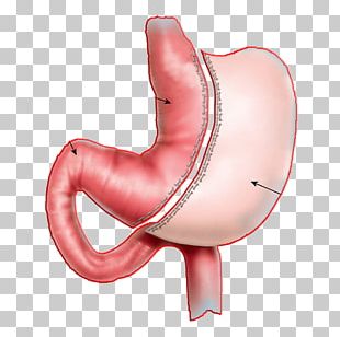 Sleeve Gastrectomy Gastric Bypass Surgery Adjustable Gastric Band Bariatric Surgery PNG