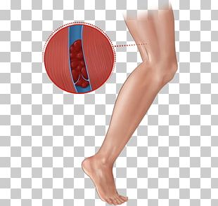 deep vein thrombosis in thigh