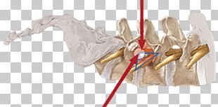 Vertebral Column Surgery Spinal Disc Herniation Endoscopy Intervertebral Foramen PNG