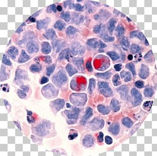Acute Myeloid Leukemia Cancer Gemtuzumab Ozogamicin Acute Lymphoblastic Leukemia PNG