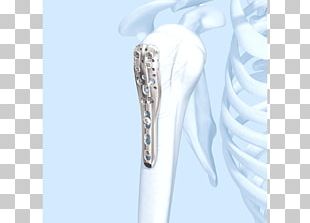 Shoulder Humerus Fracture Bone Diaphysis PNG