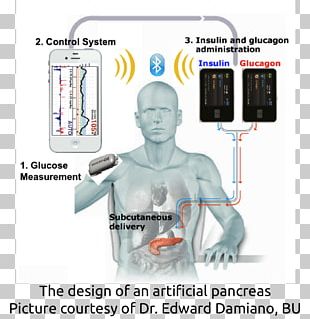 Artificial Pancreas Diabetes Mellitus Type 2 Blood Sugar PNG
