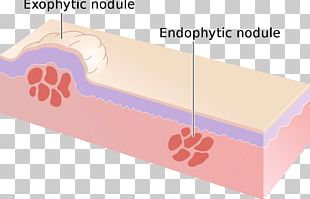 Rheumatoid Nodule Thyroid Nodule Cutaneous Condition Papule PNG