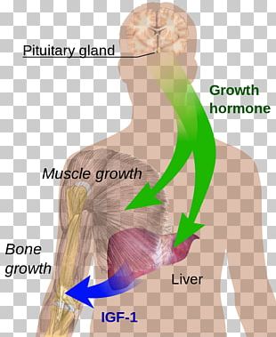 Acromegaly Gigantism Face Growth Hormone PNG, Clipart, Acromegaly ...