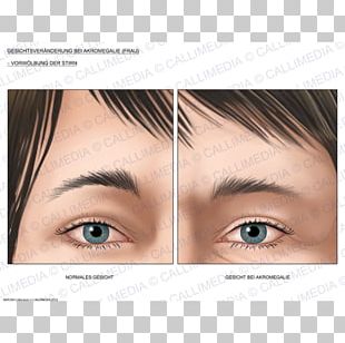 Acromegaly Gigantism Face Symptom Growth Hormone PNG, Clipart ...